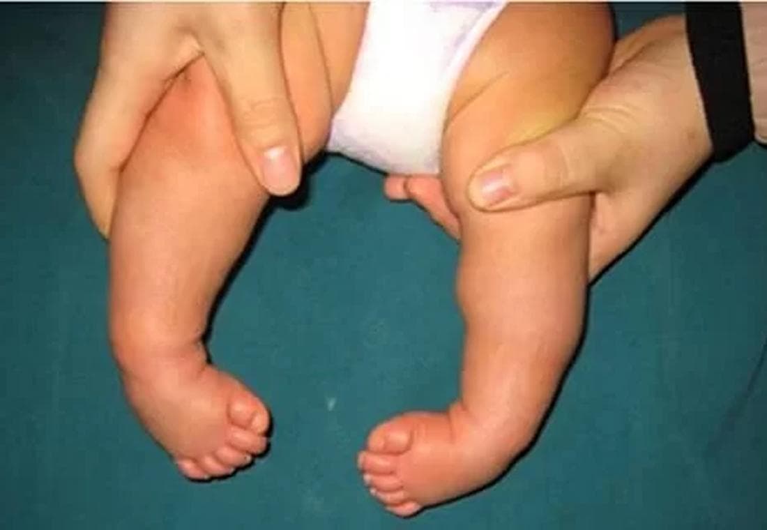 پای پرانتزی